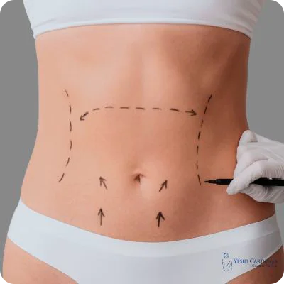 lipo abdominoplastia medellin colombia