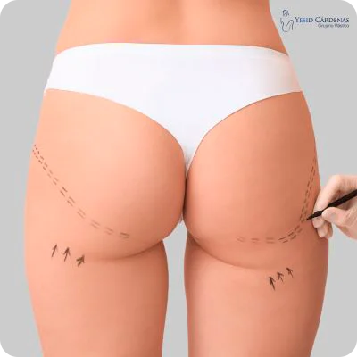Medellin colombia gluteoplastia