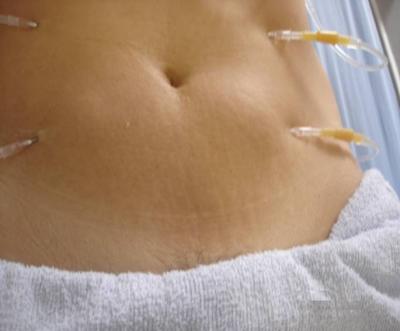 hidrolipoclasia medellin