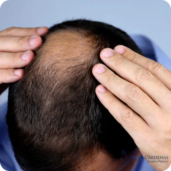 Mejor Injerto de cabello Medellín
