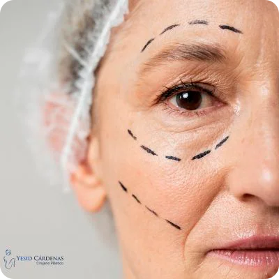 colombia ritidoplastia 